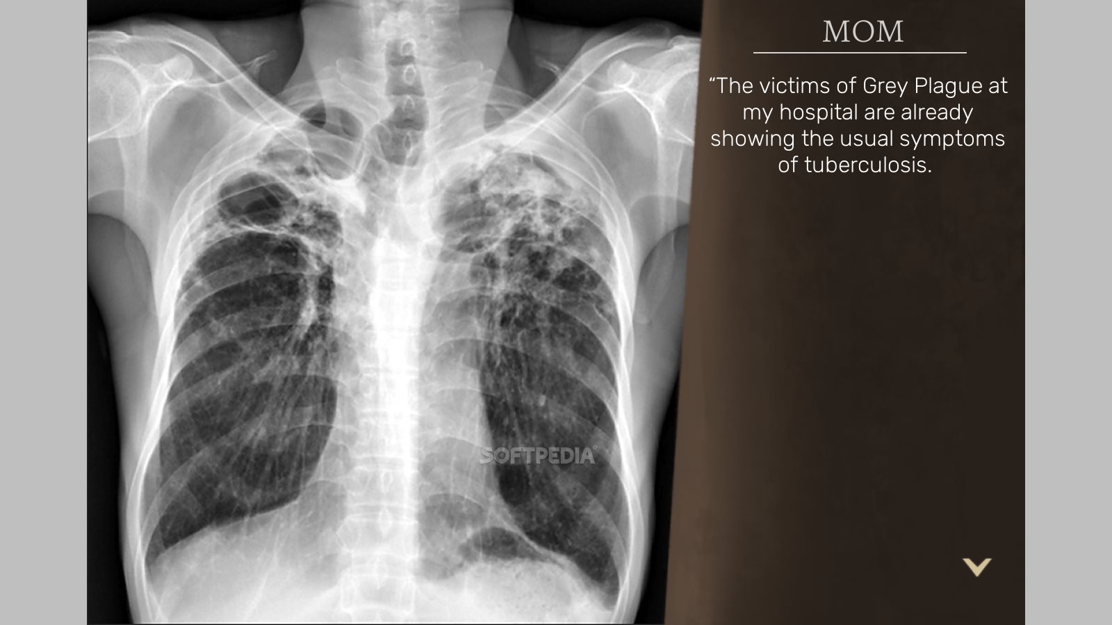 Снимок лёгких с туберкулезом